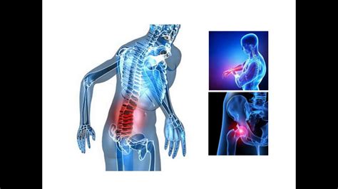 Myelom symtom